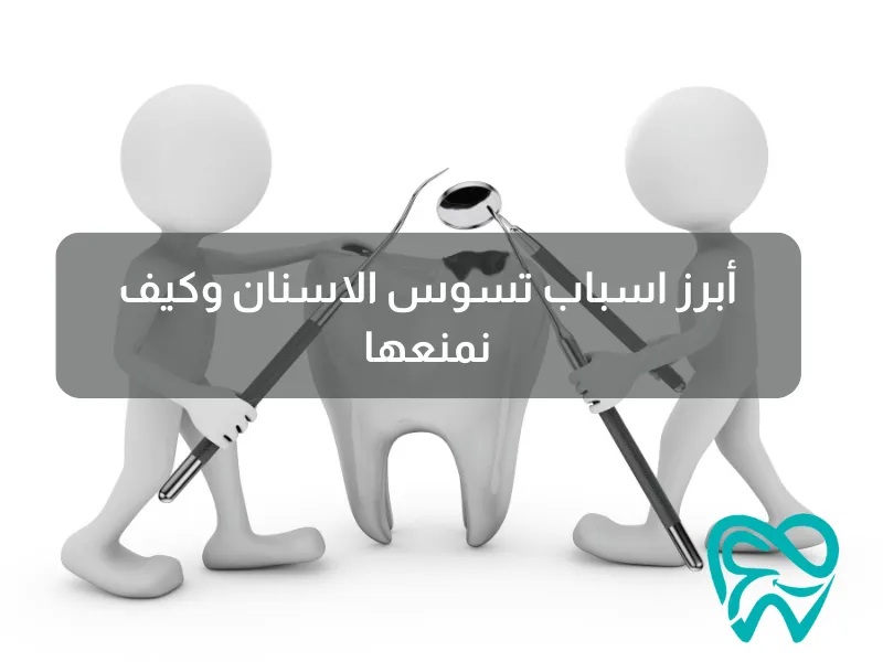 أبرز اسباب تسوس الاسنان وكيف نمنعها