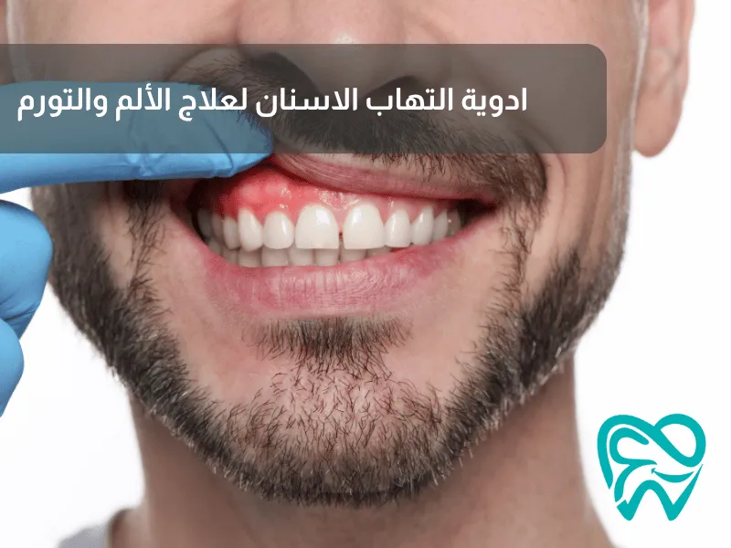 ادوية التهاب الاسنان لعلاج الألم والتورم